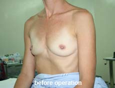 plastic-surgery-breast-augmentation 